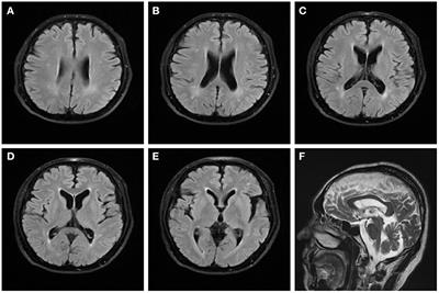 Hereditary spastic paraplegia (SPG 48) with deafness and azoospermia: A case report